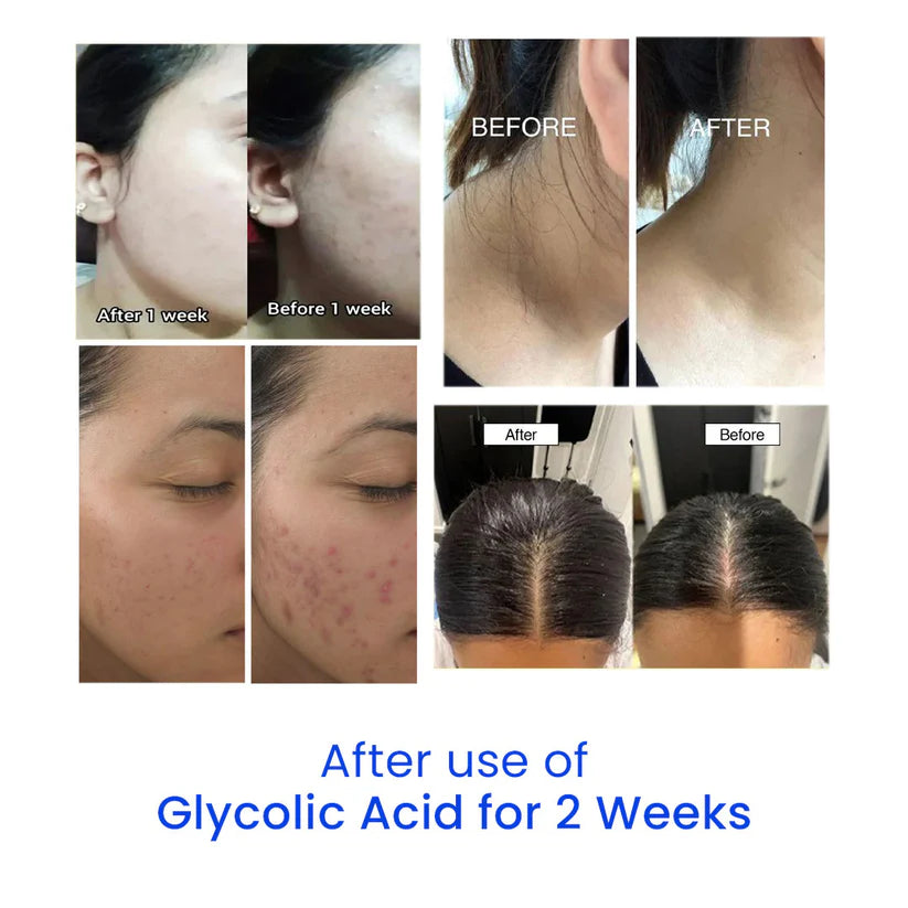 Urapra Glycolic Acid 7% Face Toner – Brightens, Smooths & Fades Dark Spots